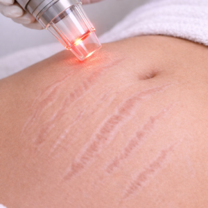 LASER CO2 CICATRICES DE ESTRIAS ABDOMEN