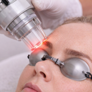 LASER CO2 REJUVENECIMIENTO DE OJOS