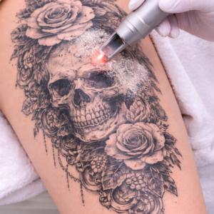 LASER ND YAG - TATUAJE TINTA NEGRA 30 CM