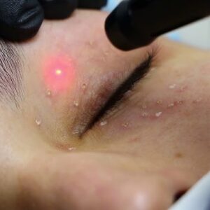 LASER CO2 SIRINGOMAS